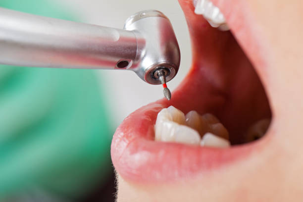 Best Emergency Dental Extractions in Frontenac, KS